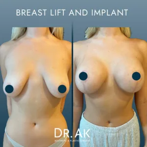 Breast Lift And Breast Implant Before After Vorher und Nachher Brustlift und Brustimplantate