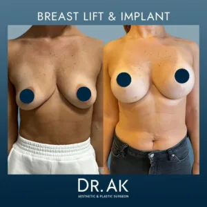 Breast Lift with Implants (Augmentation-Mastopexy)