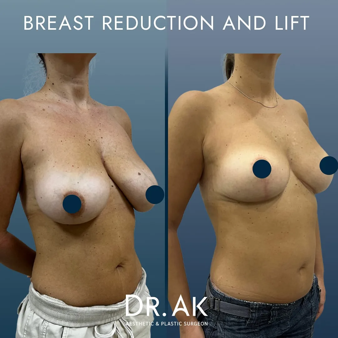 Breast Reduction and Lift before after 1 1 Ergebnis von Brustverkleinerung und -straffung