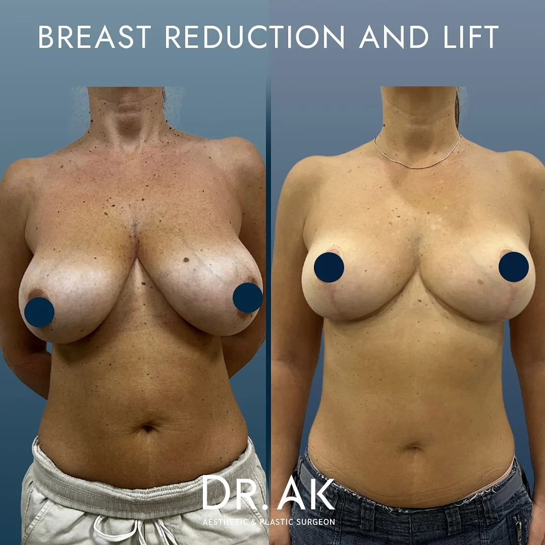 Breast Reduction and Lift before after in turkey 1 Ergebnis von Brustverkleinerung und -straffung