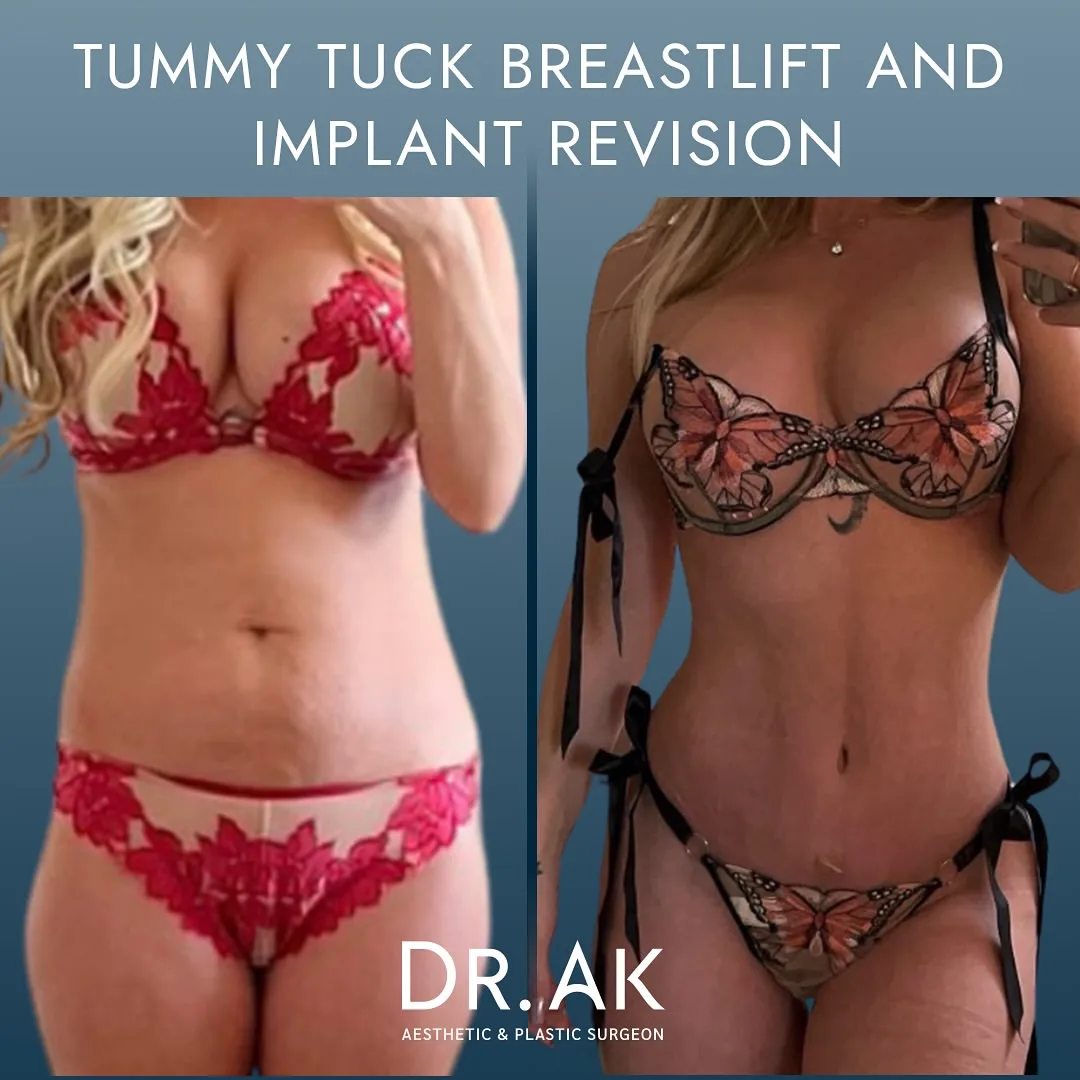 tummy tuck and breastlift before after