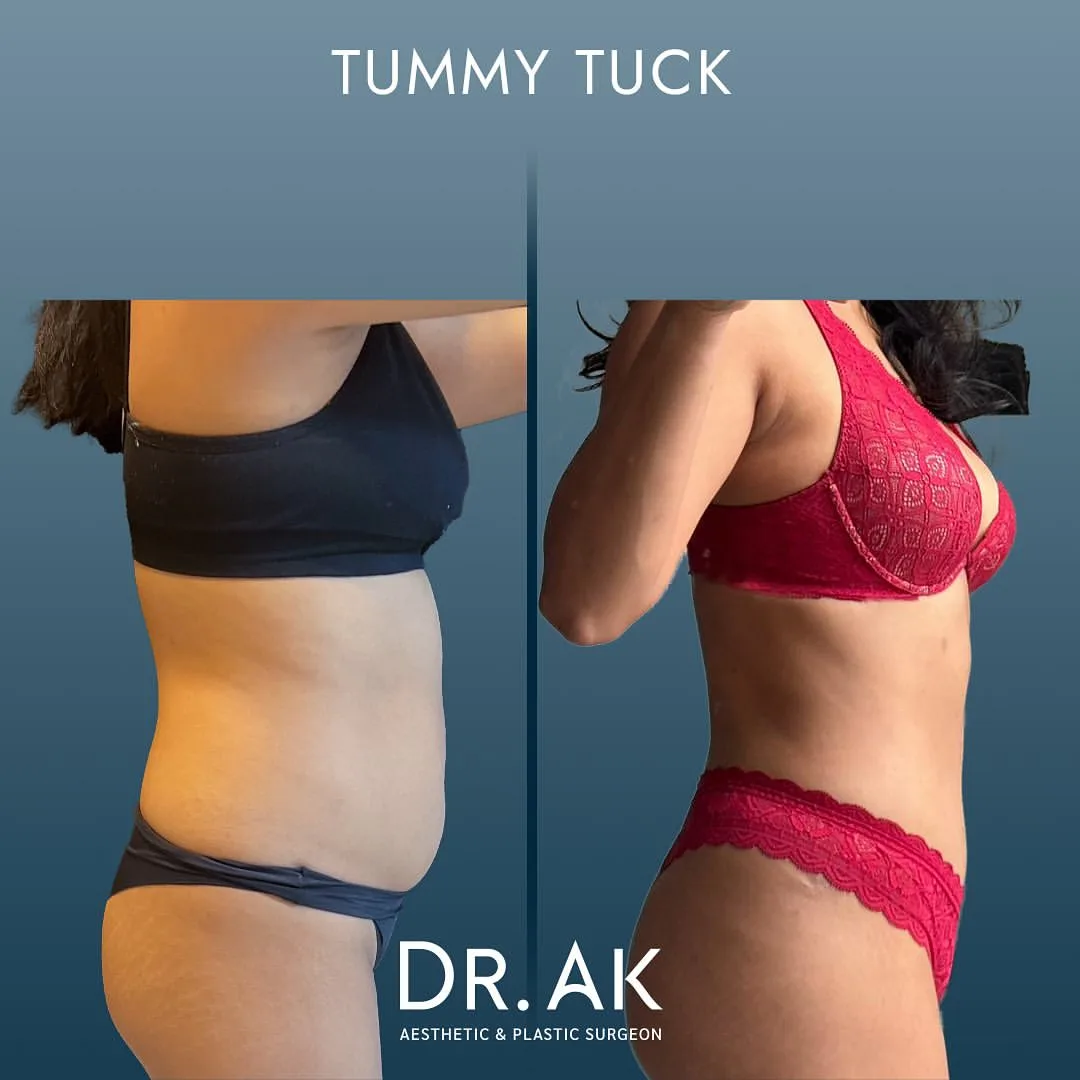 tummy tuck before after in istanbul Vorher und Nachher Bauchdeckenstraffung aus den Niederlanden