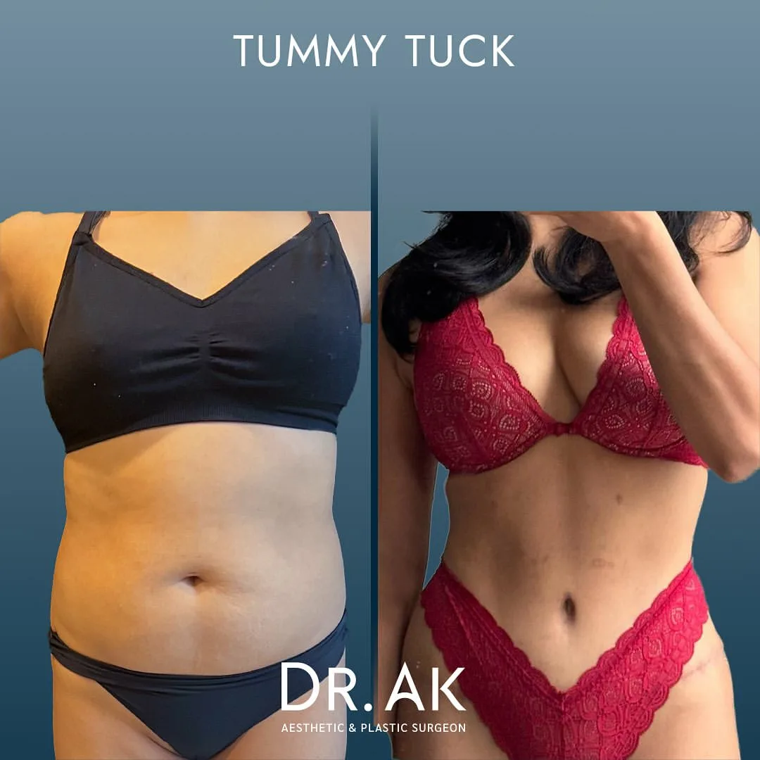 tummy tuck before after turkey Vorher und Nachher Bauchdeckenstraffung aus den Niederlanden