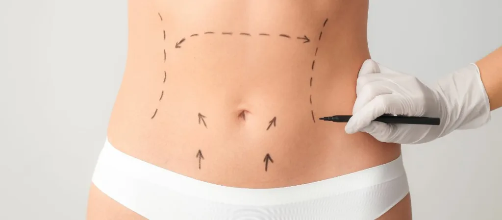 Liposuction Mi Karin Germe Mi Liposuction Mı, Karın Germe Mi?