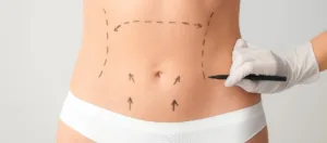 Liposuction Mi Karin Germe Mi Fettabsaugung oder Bauchdeckenstraffung?