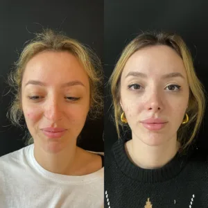 beforeafter 10 Revizyon Burun Estetiği