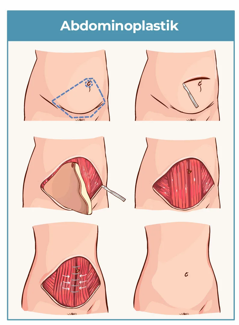 Abdominoplastik Bauchdeckenstraffung