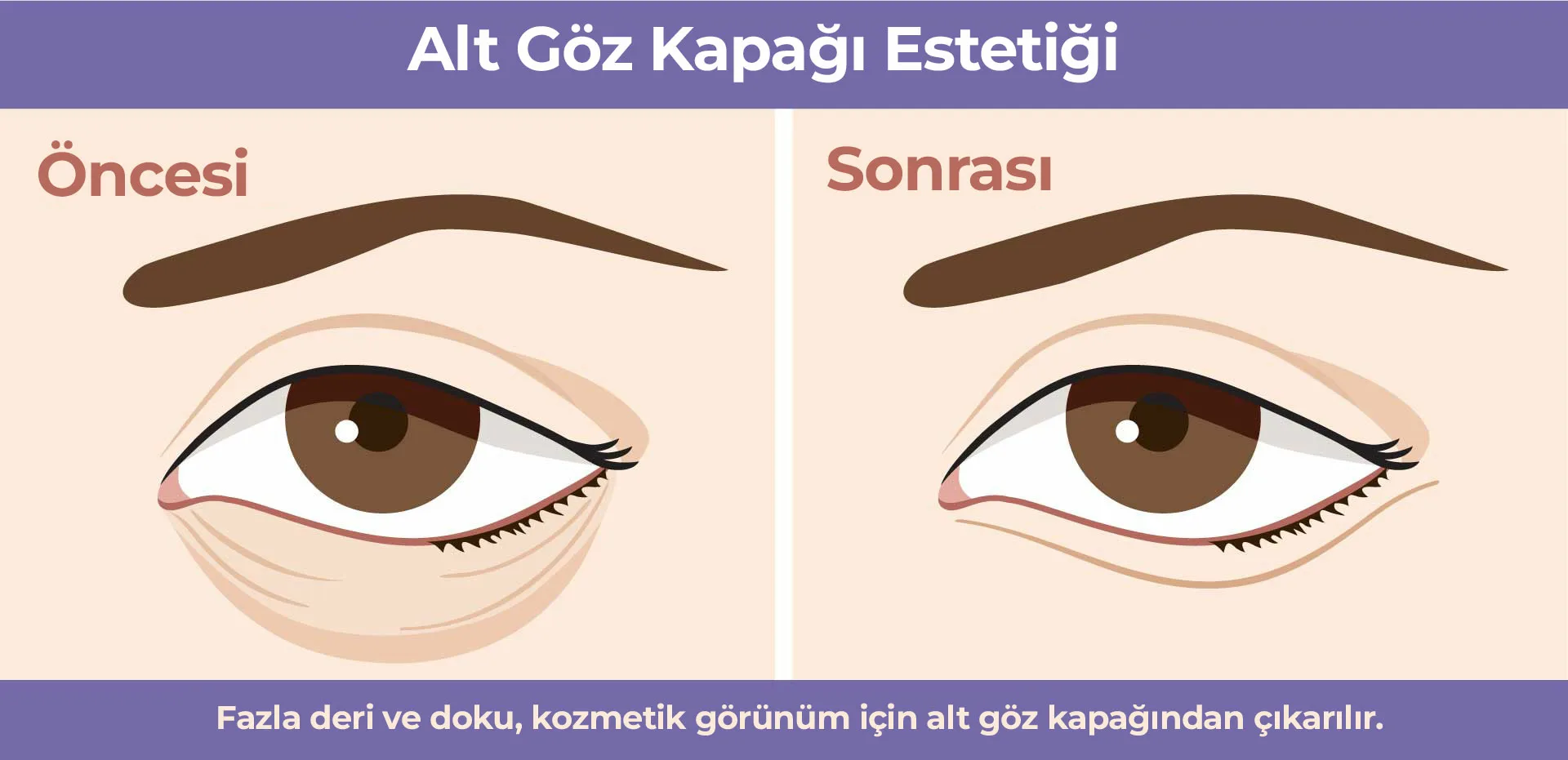 Alt Goz Kapagi Estetigi 1 Alt Göz Kapağı Estetiği