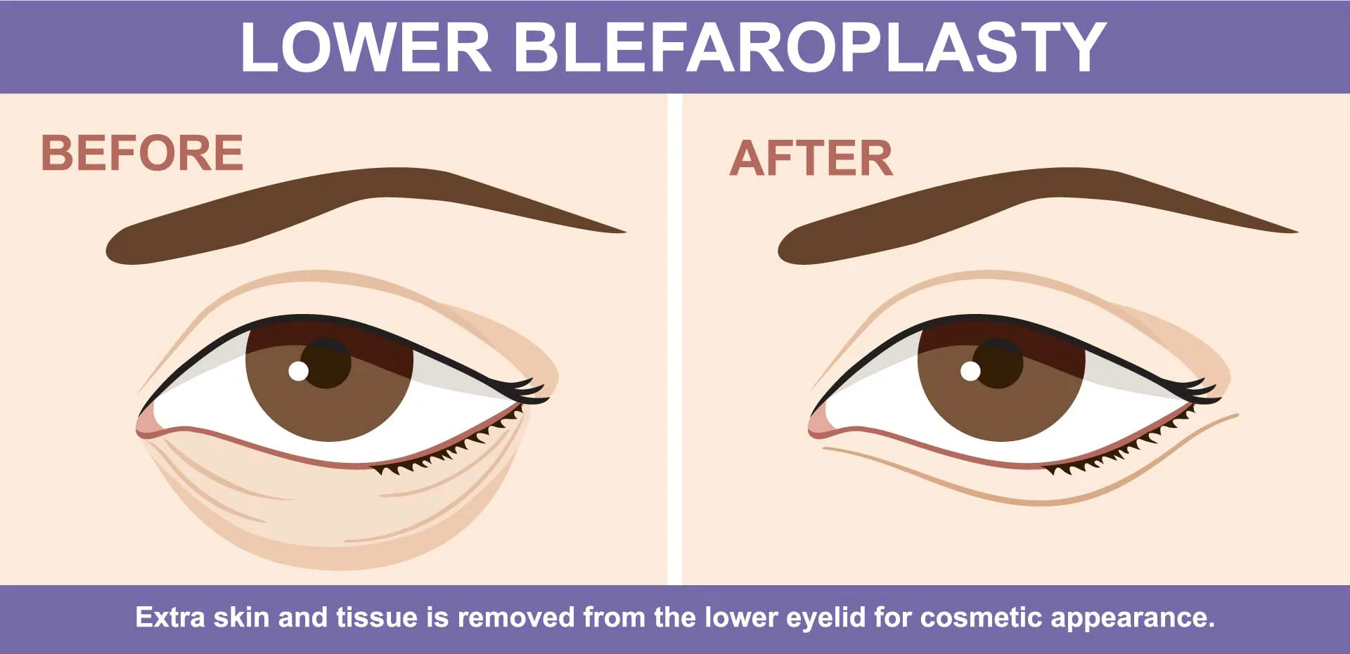 Lower Blepharoplasty before after