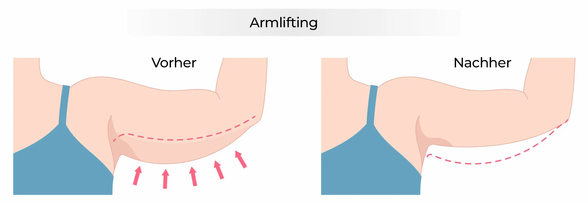 Armlifting Armstraffung