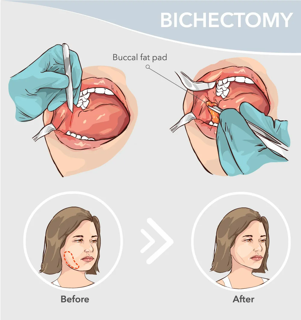 Bichectomy surgery steps