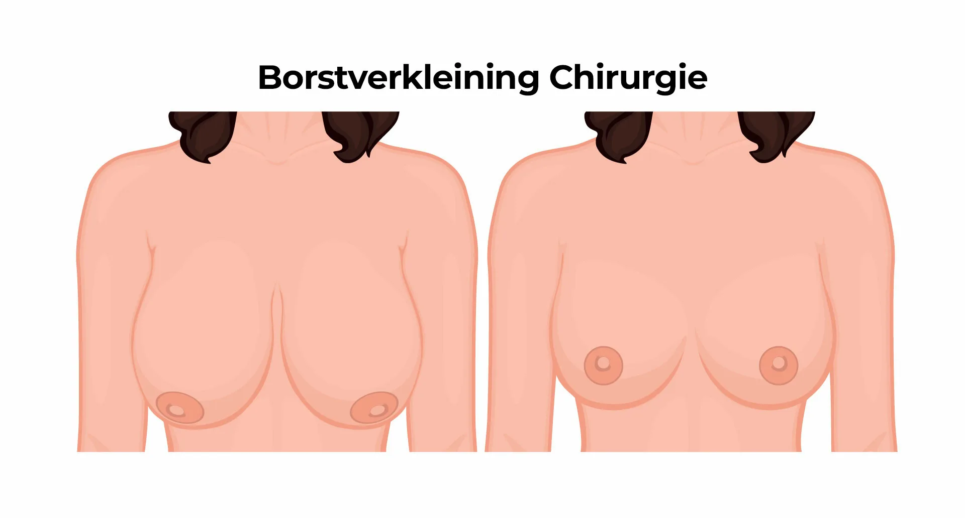 Borstverkleining Chirurgie Borstverkleining