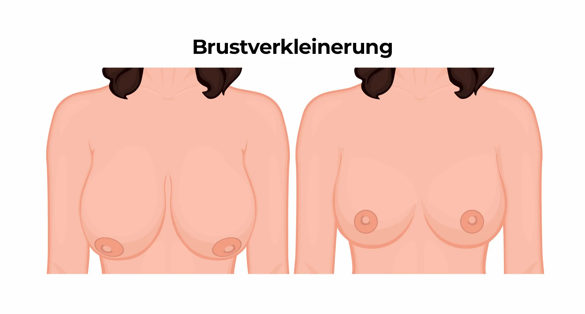 Brustverkleinerung Brustverkleinerung