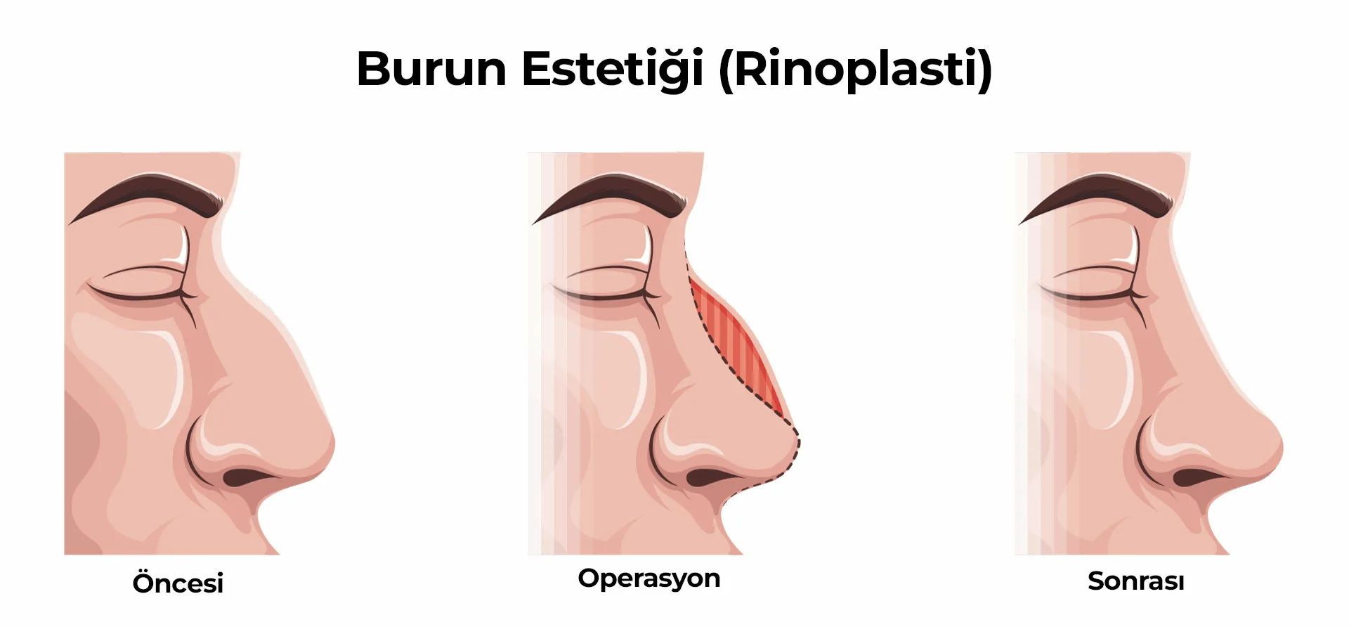 Burun Estetigi Rinoplasti 1 Burun Estetiği (Rinoplasti)