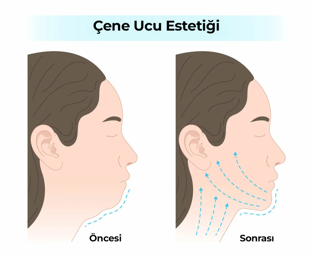 Cene Ucu Estetigi 1 Çene Ucu Estetiği