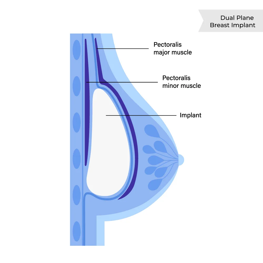 Dual Plane Breast Implant