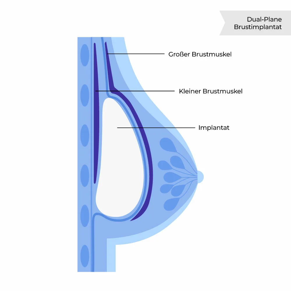 Dual Plane Brustimplantat Bruststraffung mit Vergrößerung