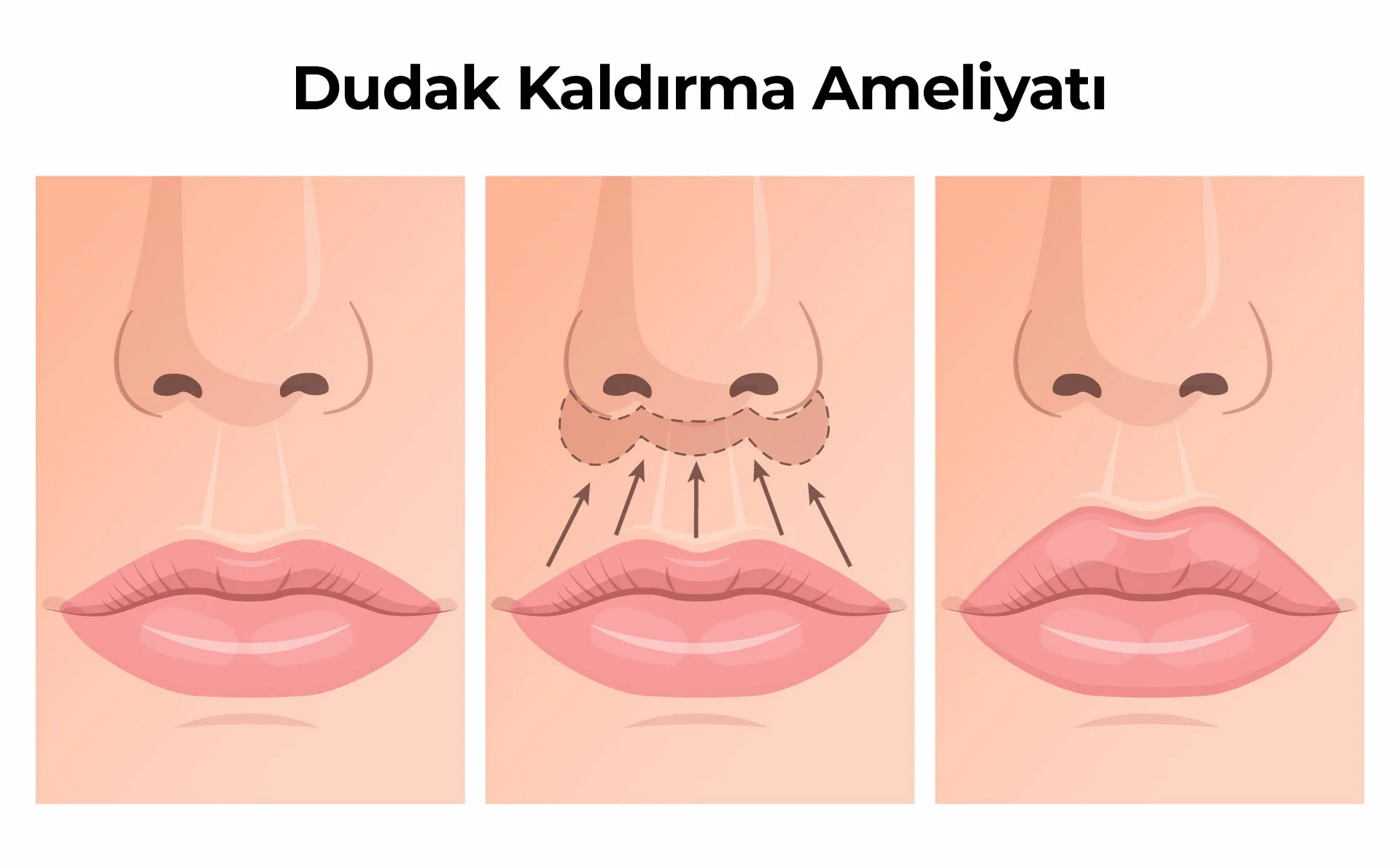 Dudak Kaldirma Ameliyati Lip Lift (Dudak Kaldırma) Ameliyatı