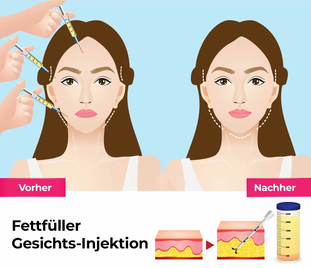 Fettfuller Gesichts Injektion Fettunterspritzung im Gesicht