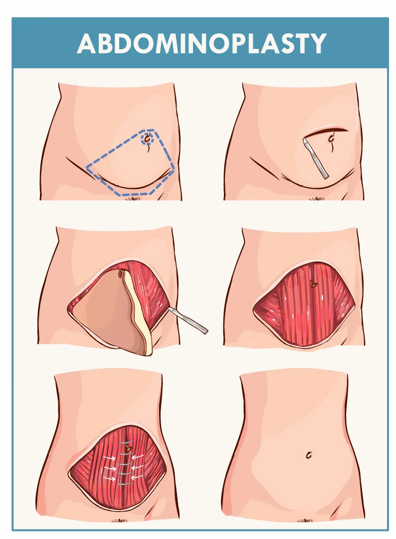 tummy tuck surgery procedure