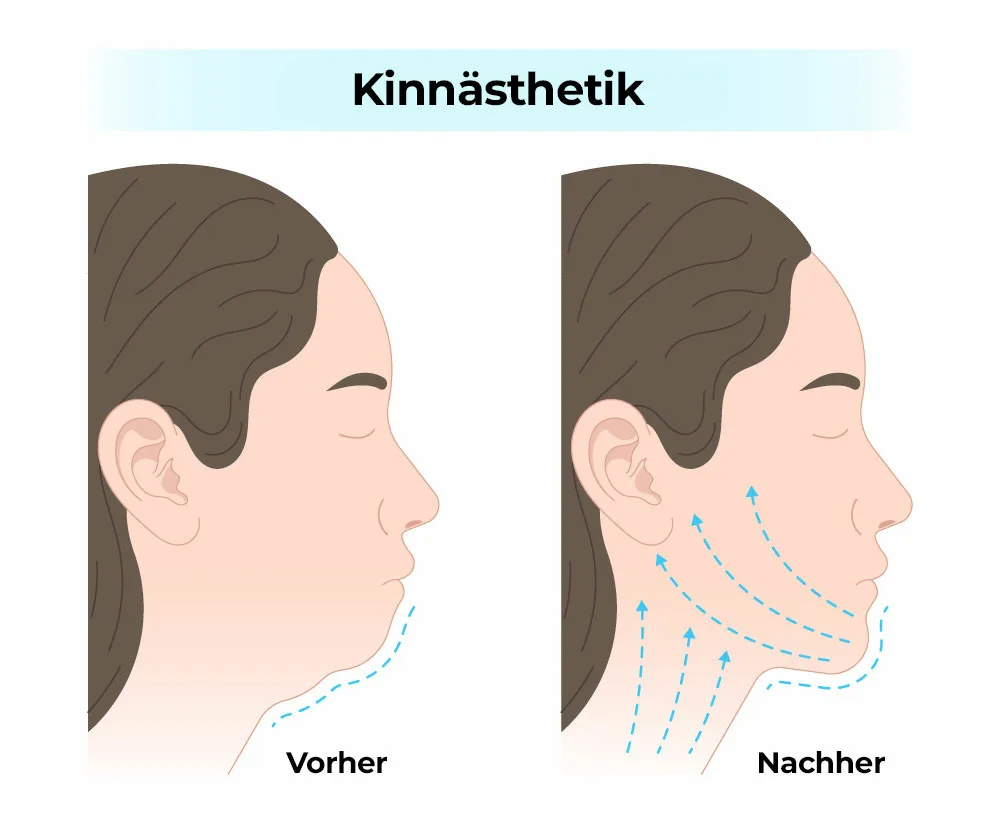 Kinnasthetik Ästhetik der Kinnspitze