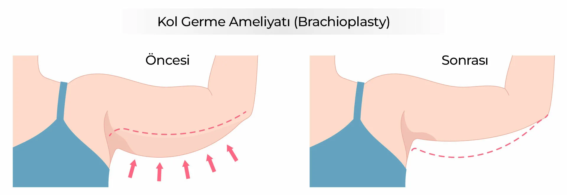 Kol Germe Ameliyati Brachioplasty Kol Germe Ameliyatı