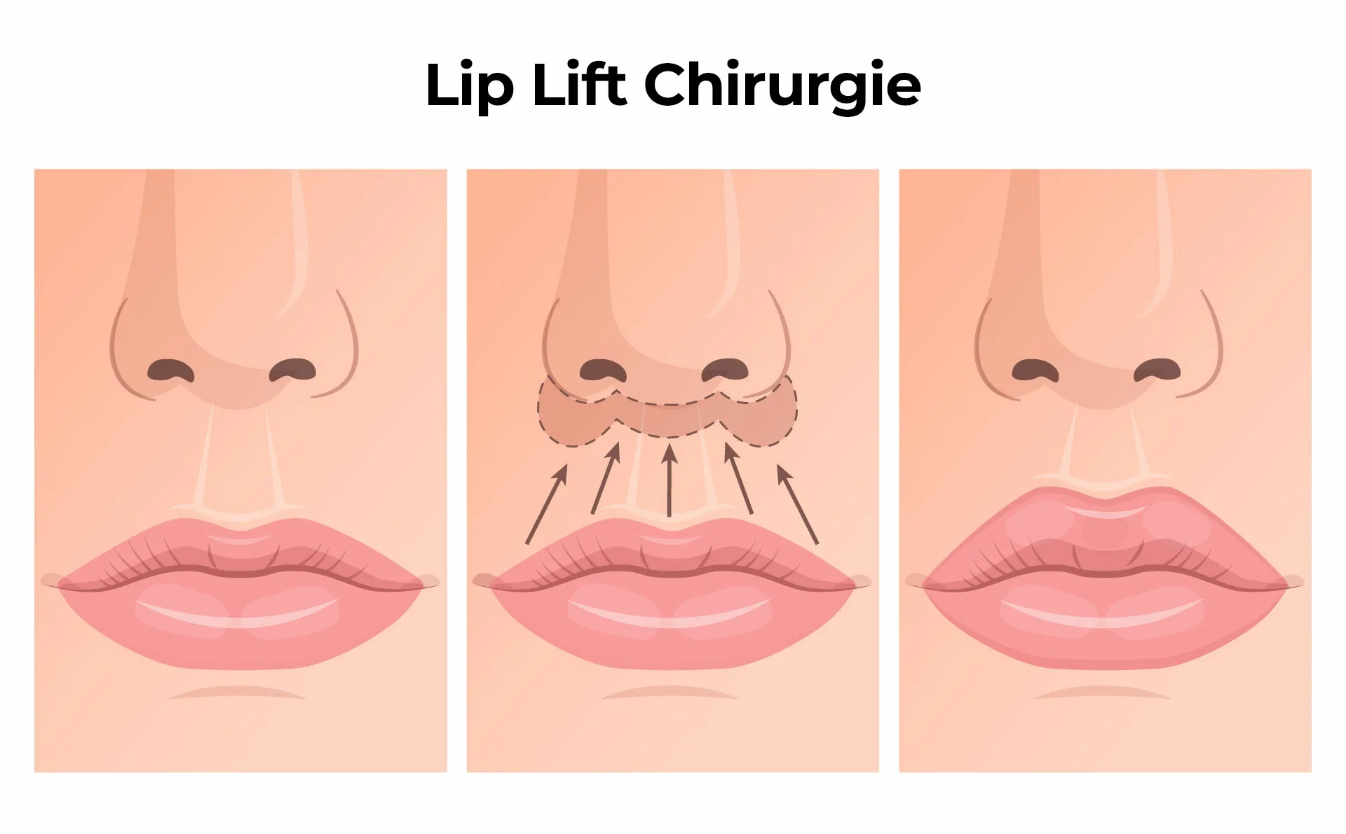 Lip Lift Chirurgie Liplift