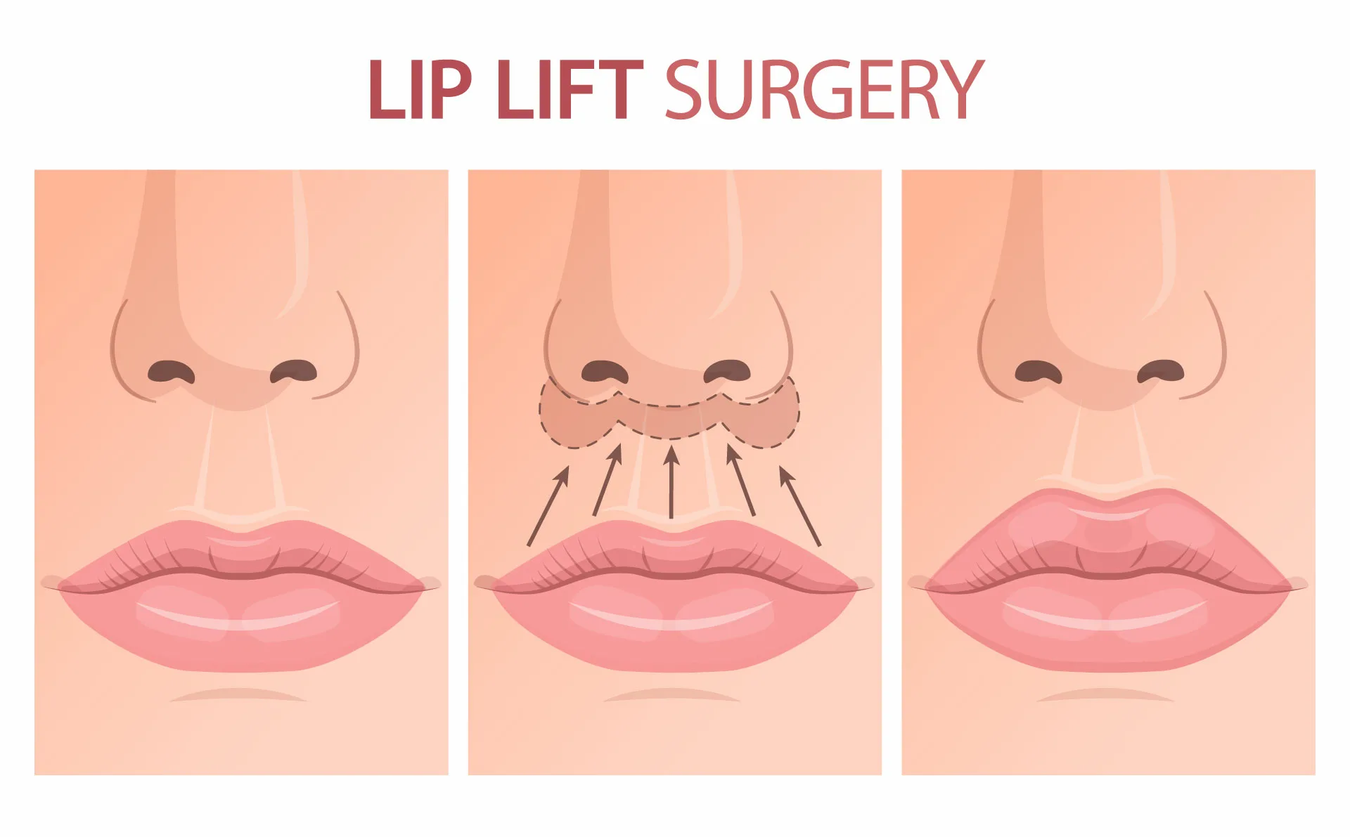 lip lift surgery procedure