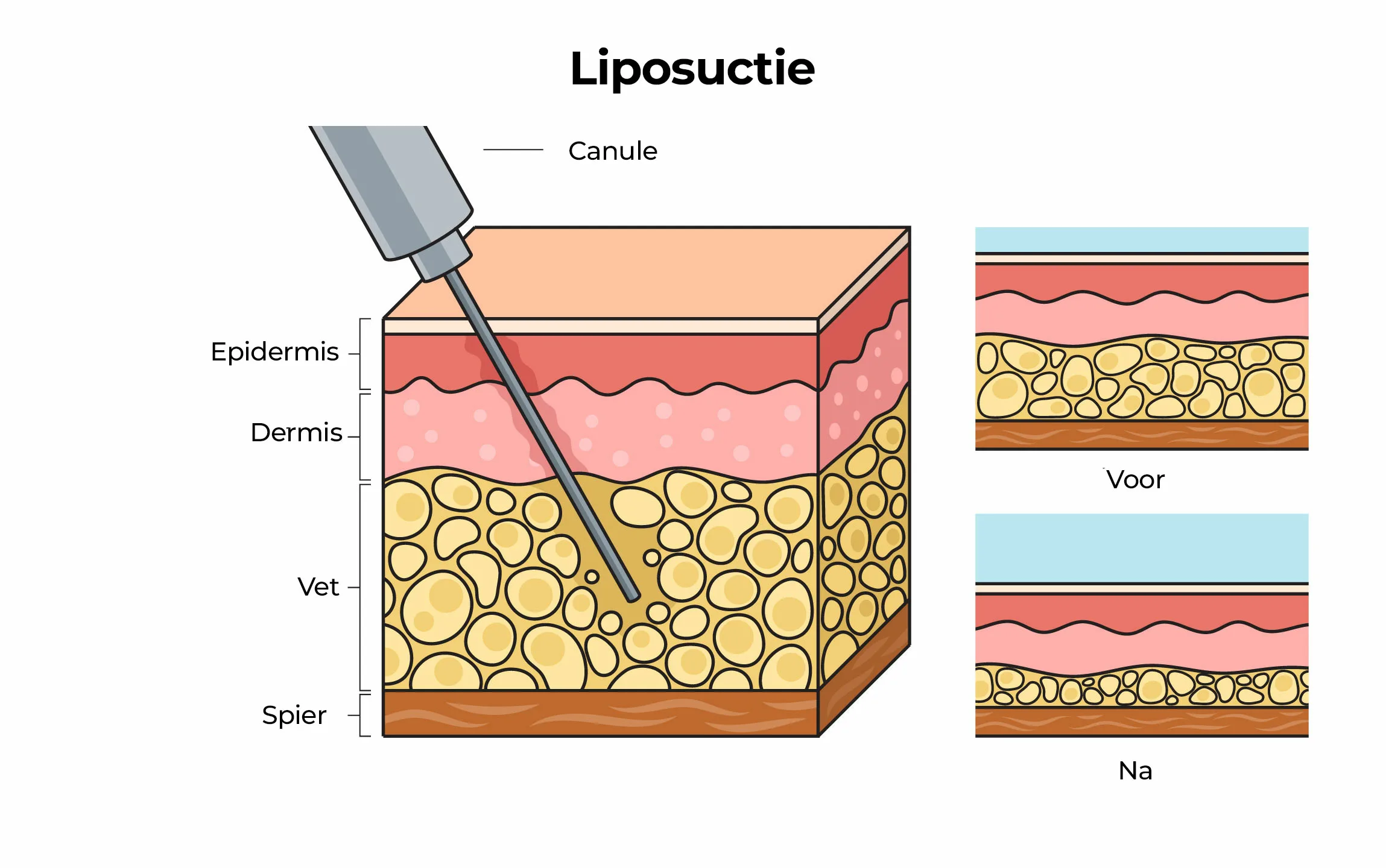 Liposuctie Liposuctie