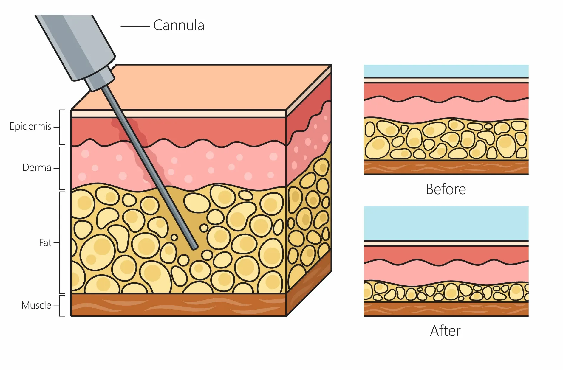 how liposuction surgery removes fat from body