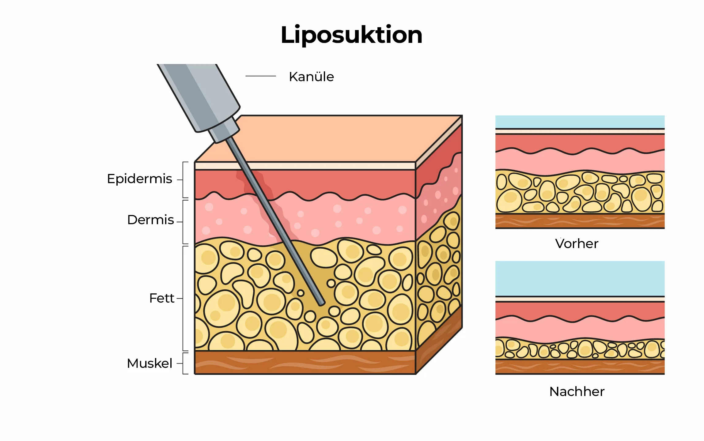 Liposuktion Fettabsaugung