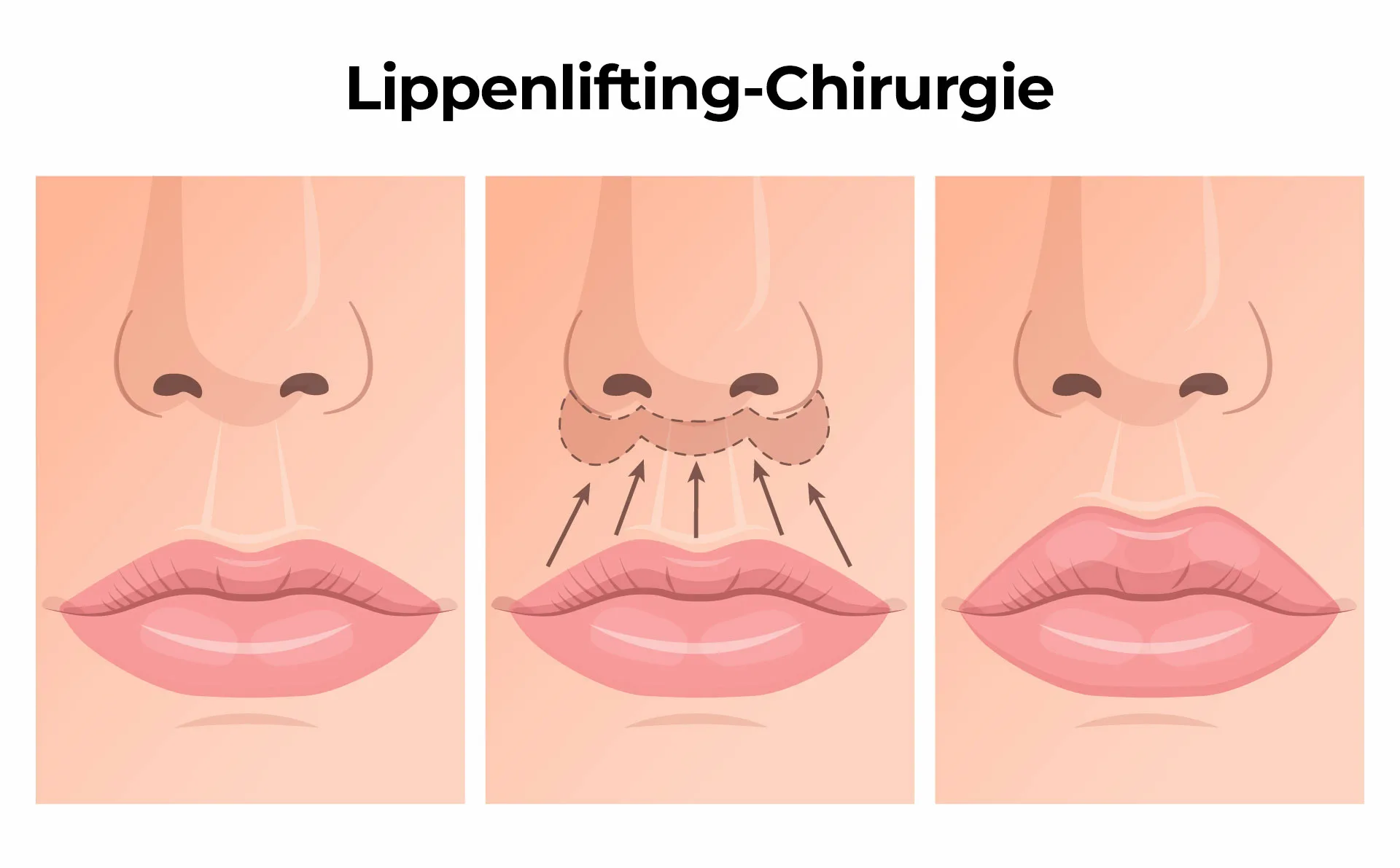 Lippenlifting Chirurgie Lippenlifting