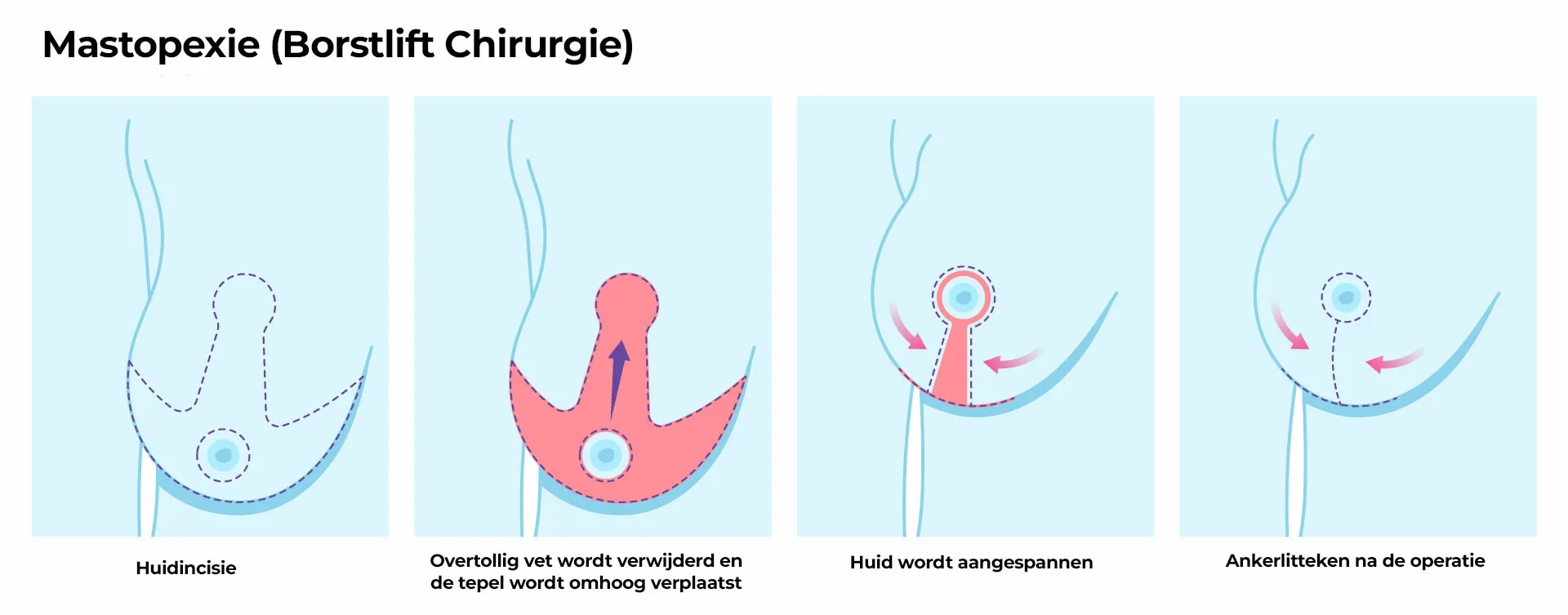 Mastopexie Borstlift Chirurgie Borstlift