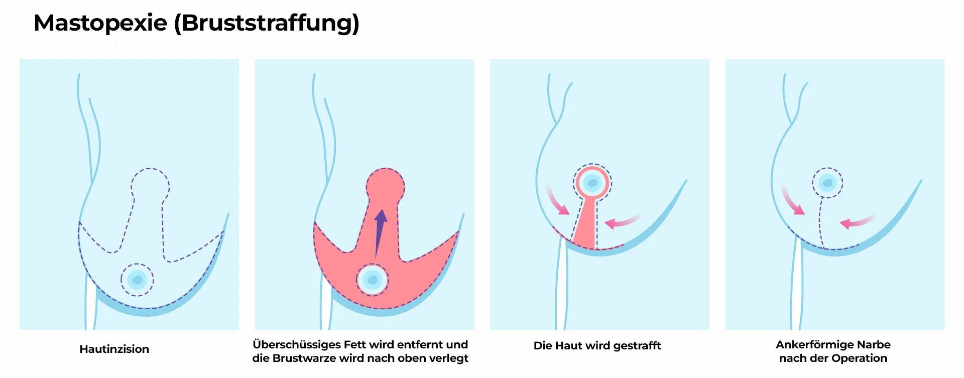 Mastopexie Bruststraffung Bruststraffung