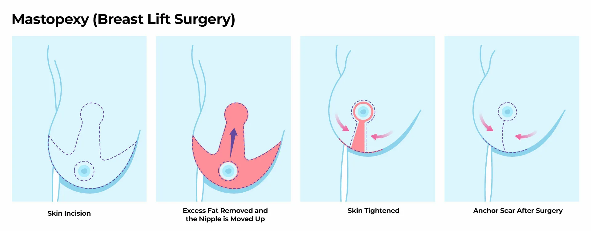 Mastopexy Breast Lift Surgery Breast Lift with Implants