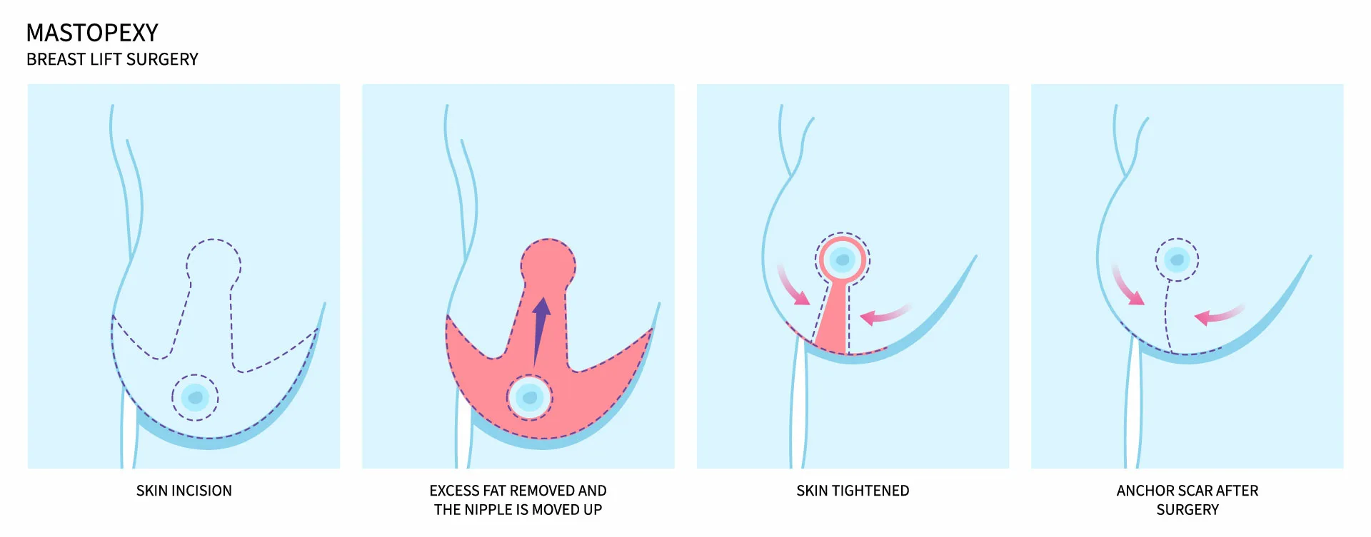 Breast lift surgery procedure