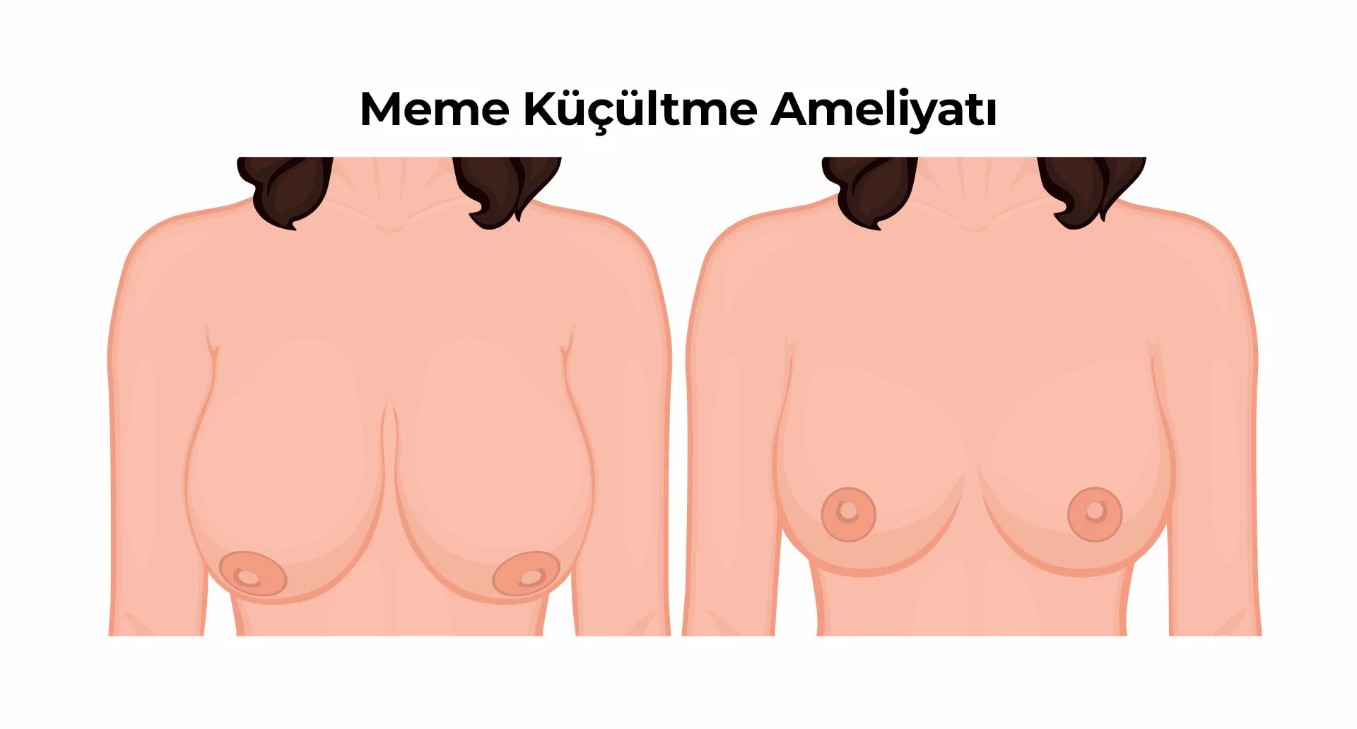 Meme Kucultme Ameliyati 1 Meme Küçültme Ameliyatı