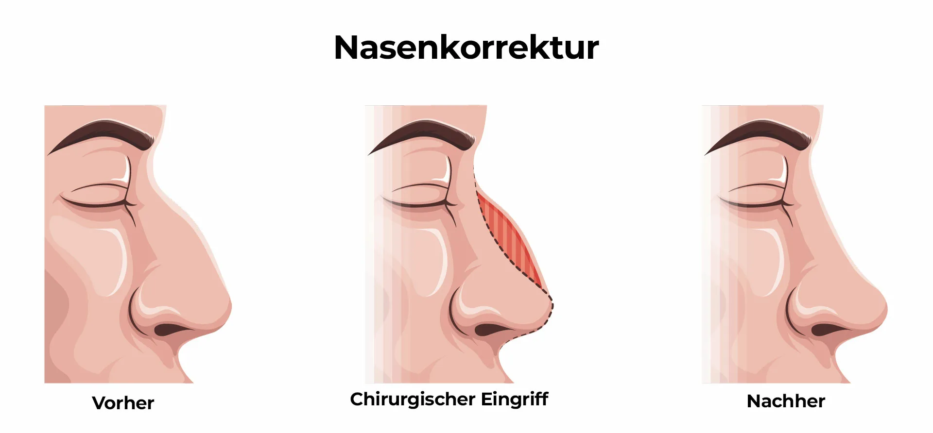 Nasenkorrektur Nasenästhetik (Rhinoplastik)