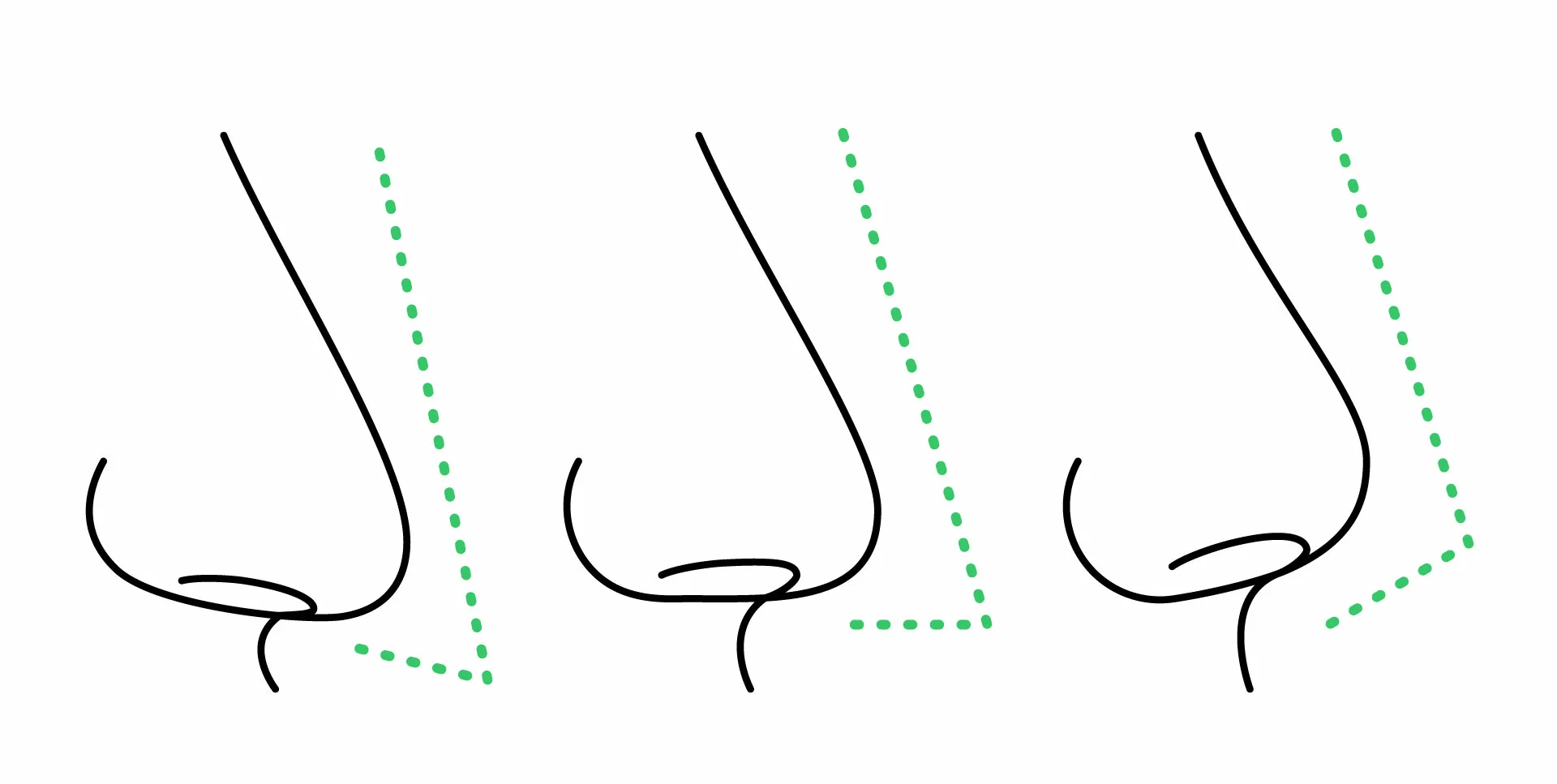 Nasenspitzenkorrektur Nasenspitzenästhetik