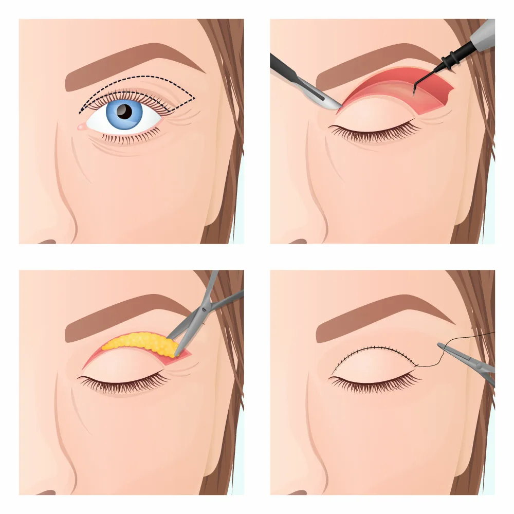 Obere Lidstraffung Oberlid Straffung (Blepharoplastik)