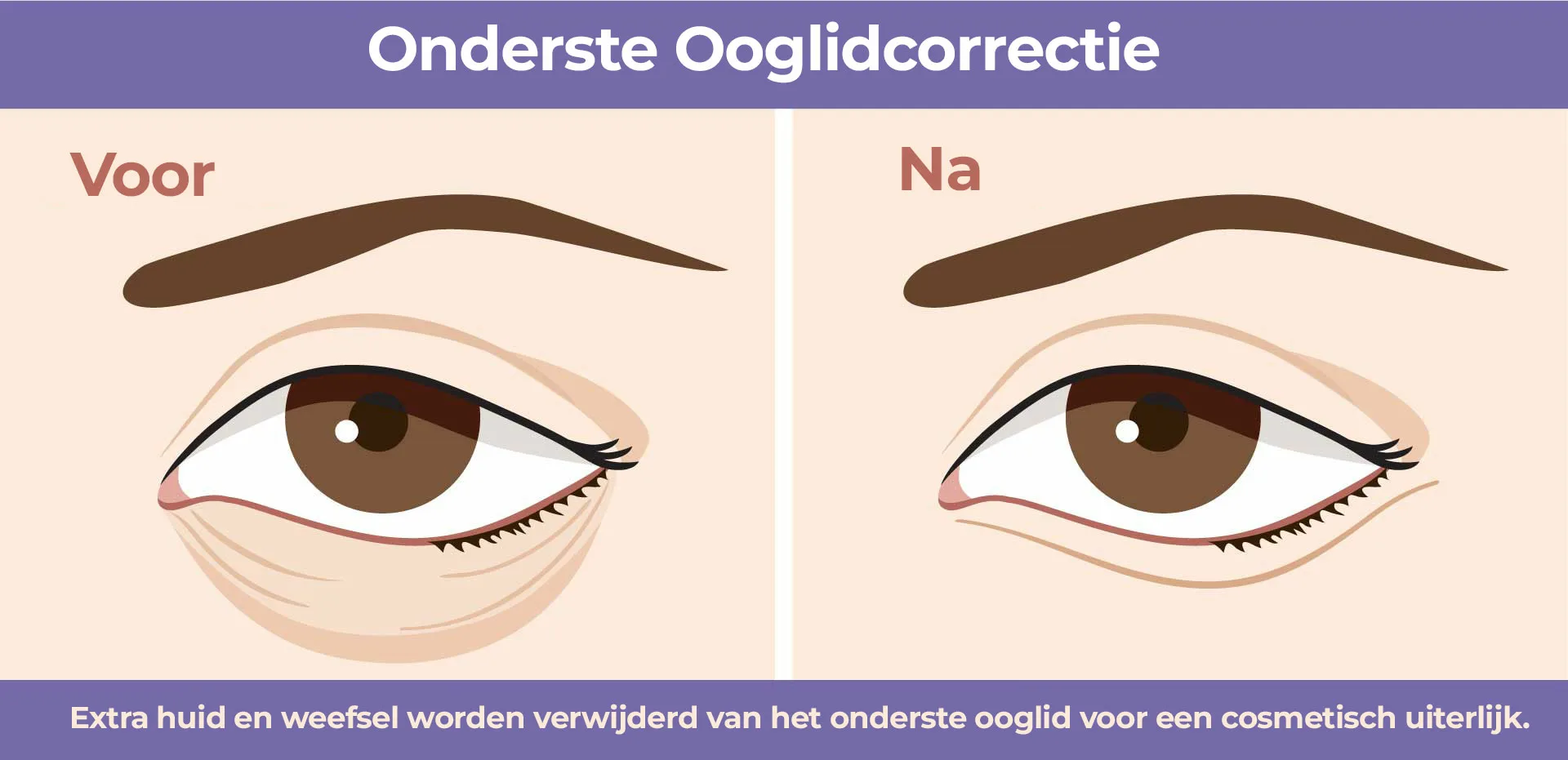 Onderste Ooglidcorrectie Onderooglidcorrectie