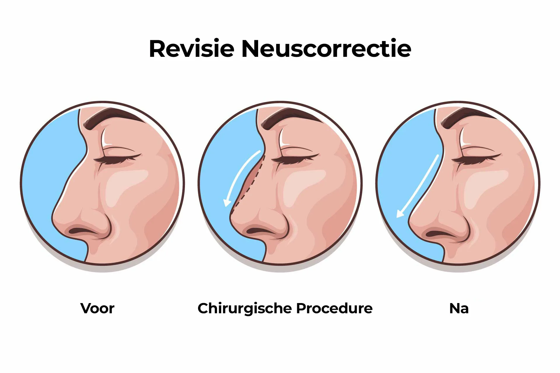 Revisie Neuscorrectie Revisie Neuscorrectie