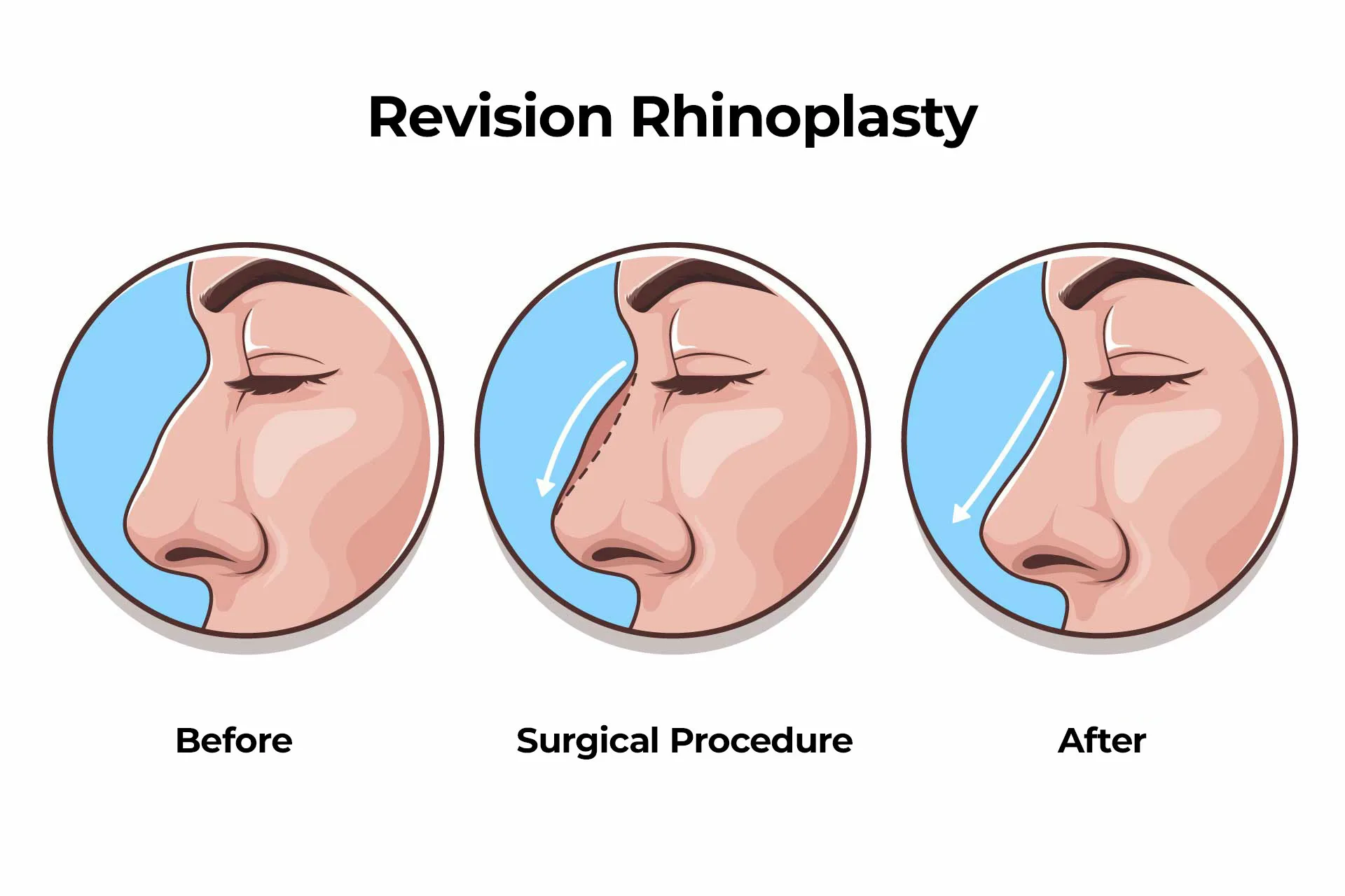 Revision Rhinoplasty Revision Rhinoplasty