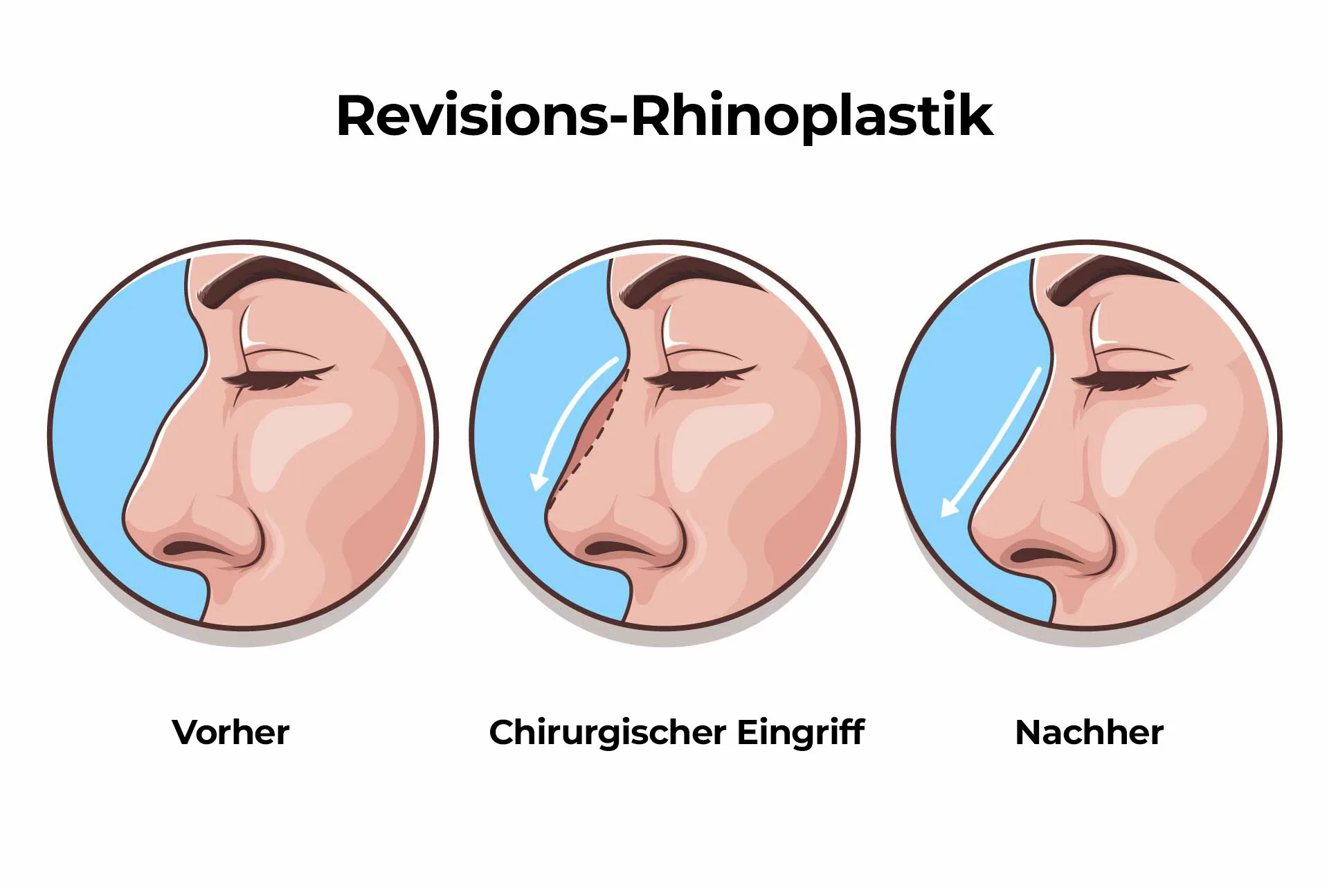 Revisions Rhinoplastik Revision Rhinoplastik