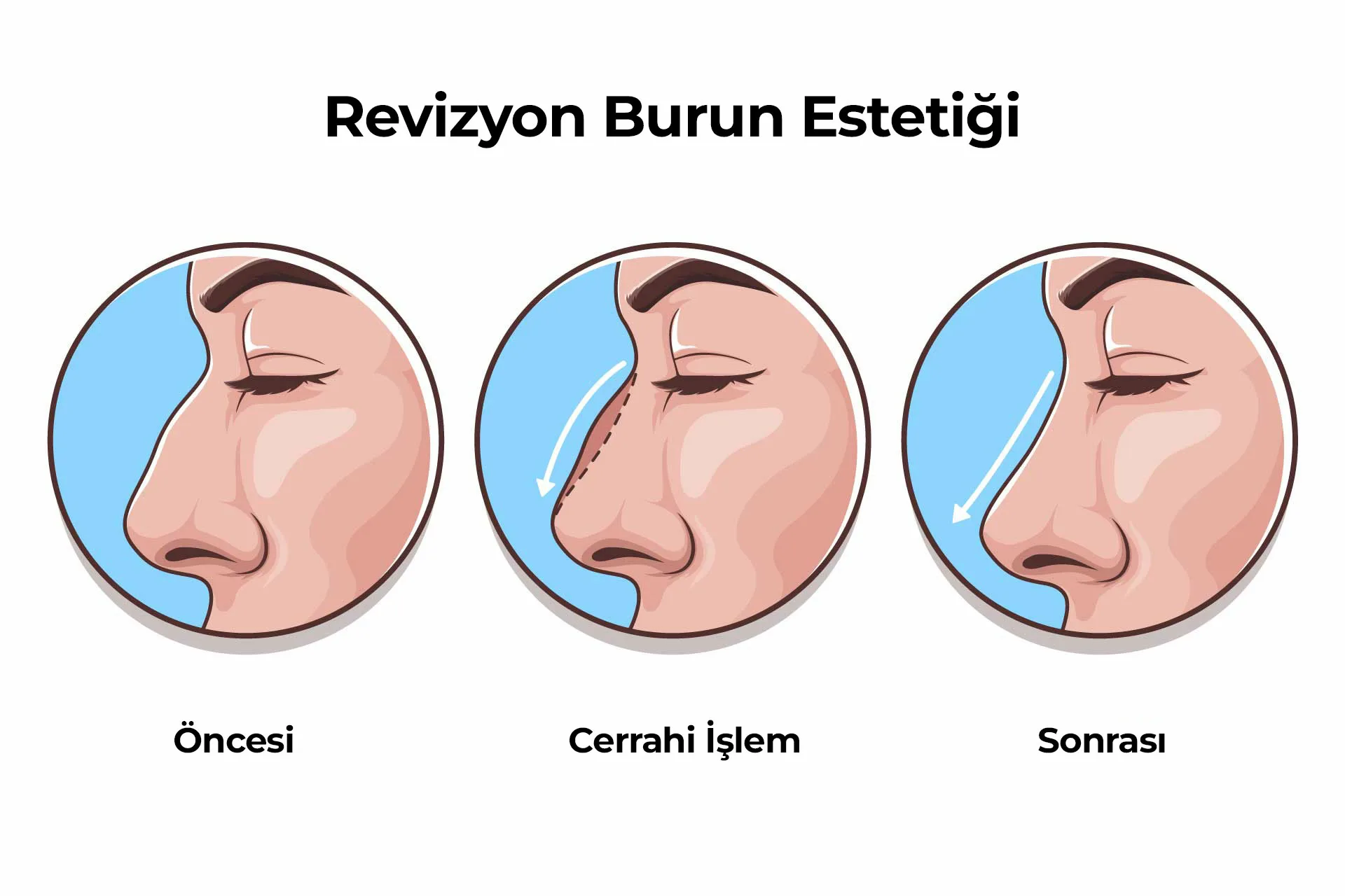 Revizyon Burun Estetigi 1 Revizyon Burun Estetiği