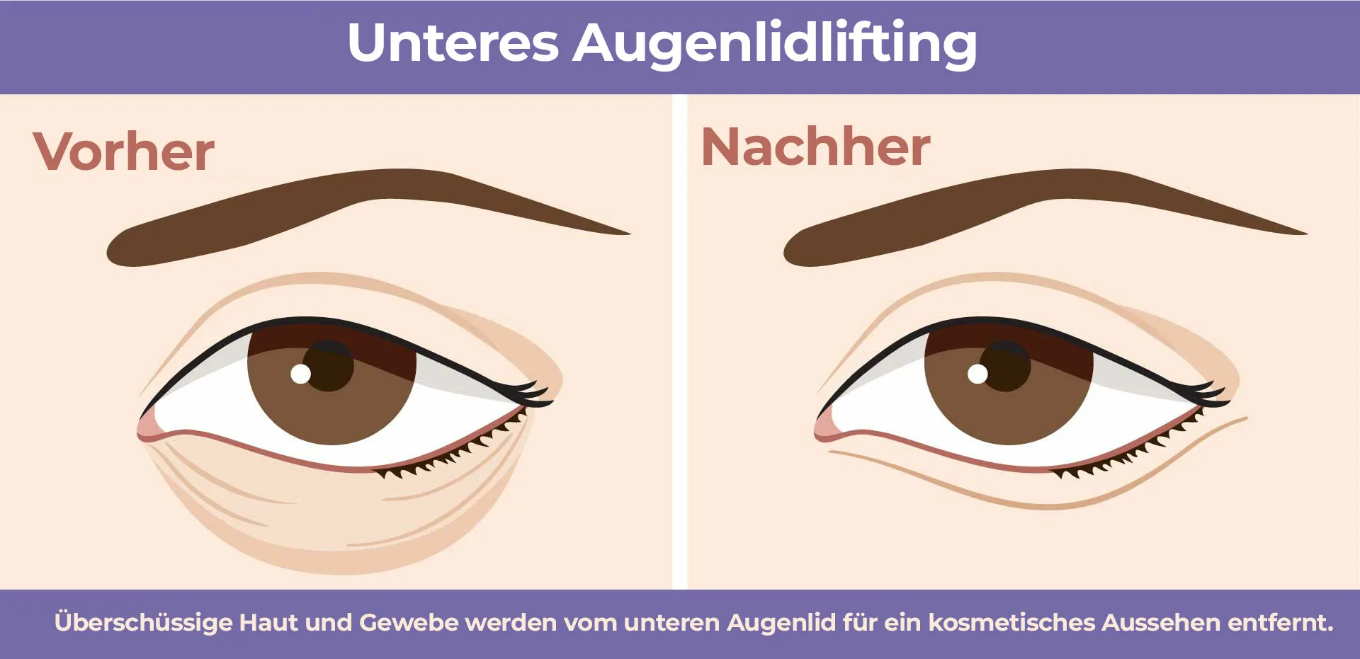 Unteres Augenlidlifting Unterlidstraffung (Untere Blepharoplastik)