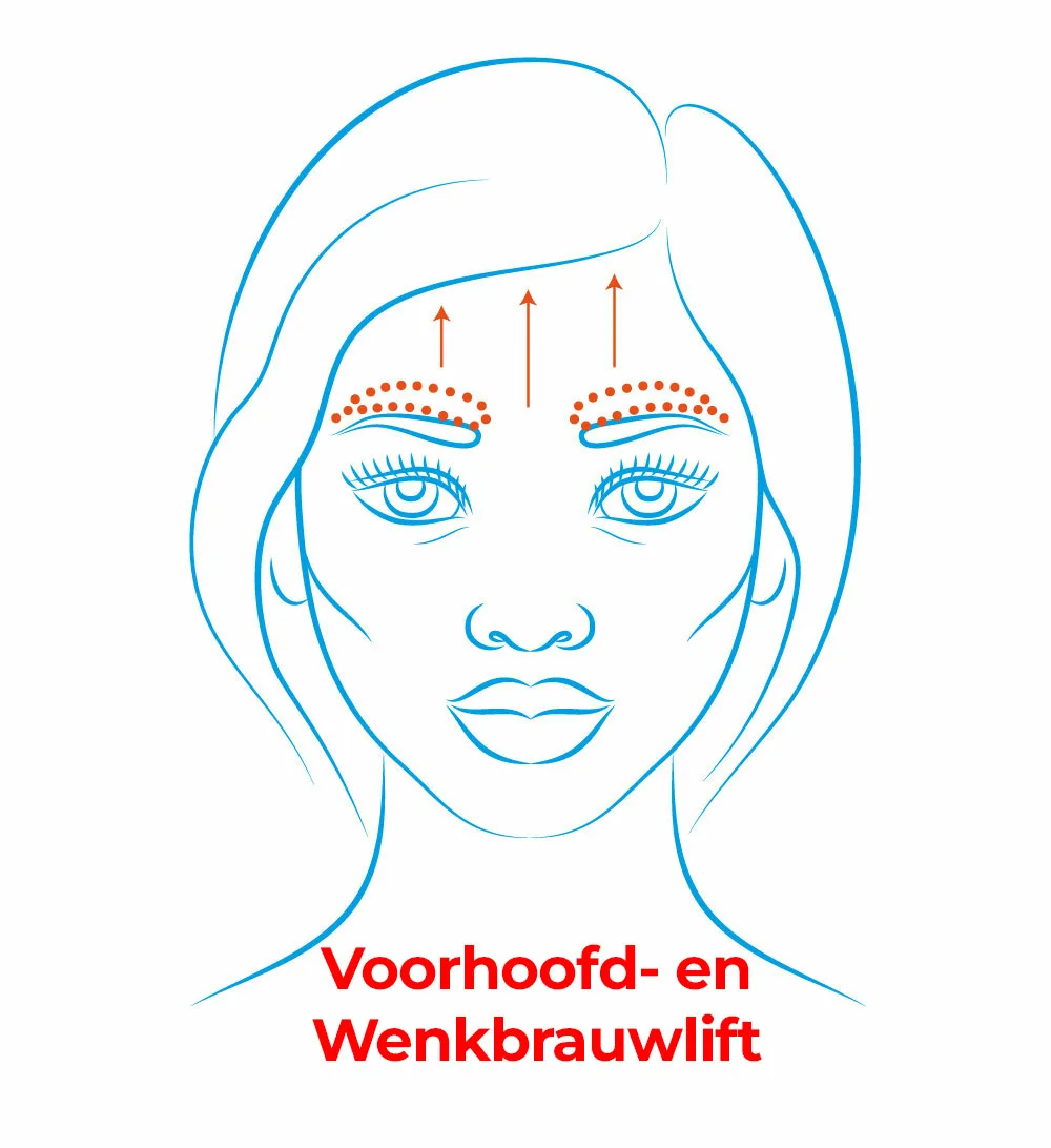 Voorhoofd en Wenkbrauwlift Voorhoofd Lift