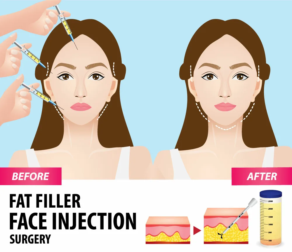 facial fat transfer