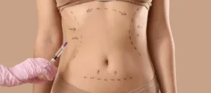 Liposuction Ameliyati Sonrasi Iyilesme Sureci Liposuction Ameliyatı Sonrası İyileşme Süreci