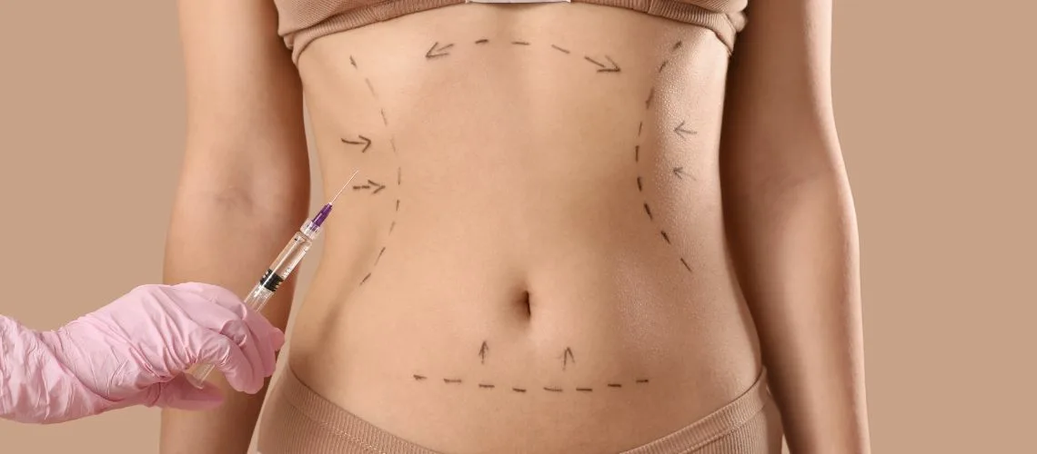 Liposuction Ameliyati Sonrasi Iyilesme Sureci Liposuction Ameliyatı Sonrası İyileşme Süreci